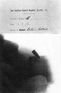 X-Ray - Bullet in buttock